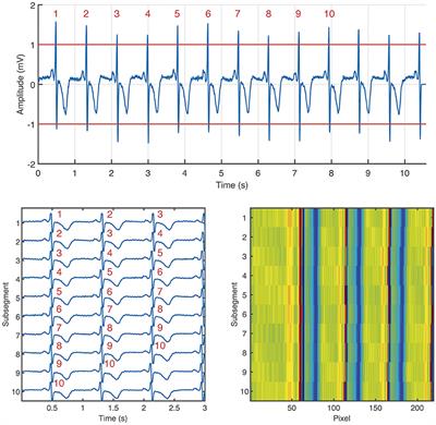 Detection of Brief Episodes of Atrial Fibrillation Based on Electrocardiomatrix and Convolutional Neural Network